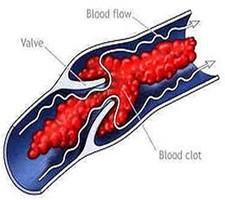 Thrombus in vene